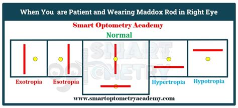 double maddox rod test|blood pressure meds and eye problems.